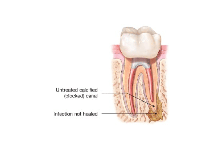 root canal infection