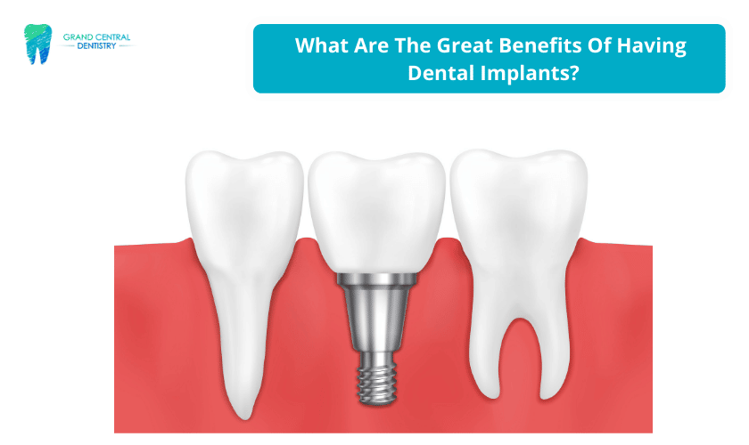 Benefits Of Having Dental Implants
