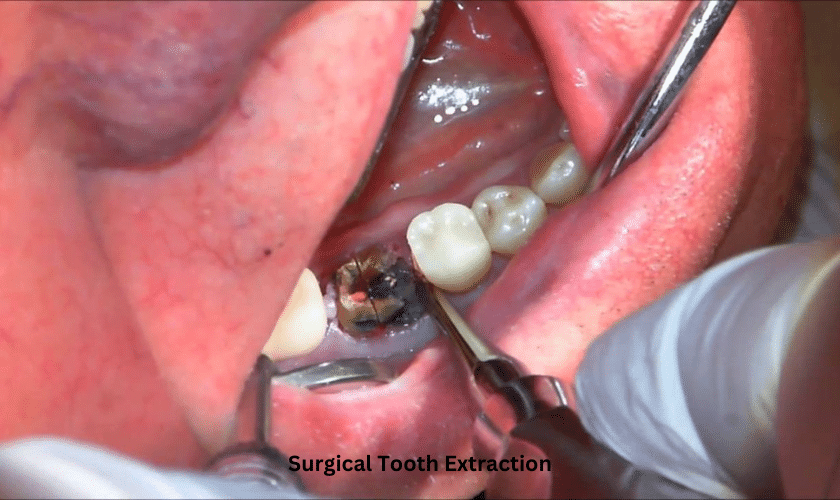 Surgical Tooth Extraction