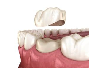 dental crowns in Conroe