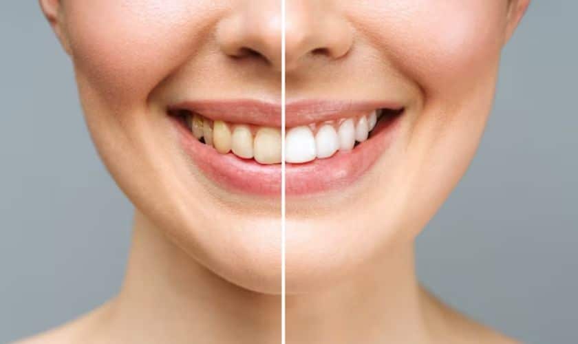 Teeth Whitening In Conroe, Grand Central Dentistry Of Conroe TX