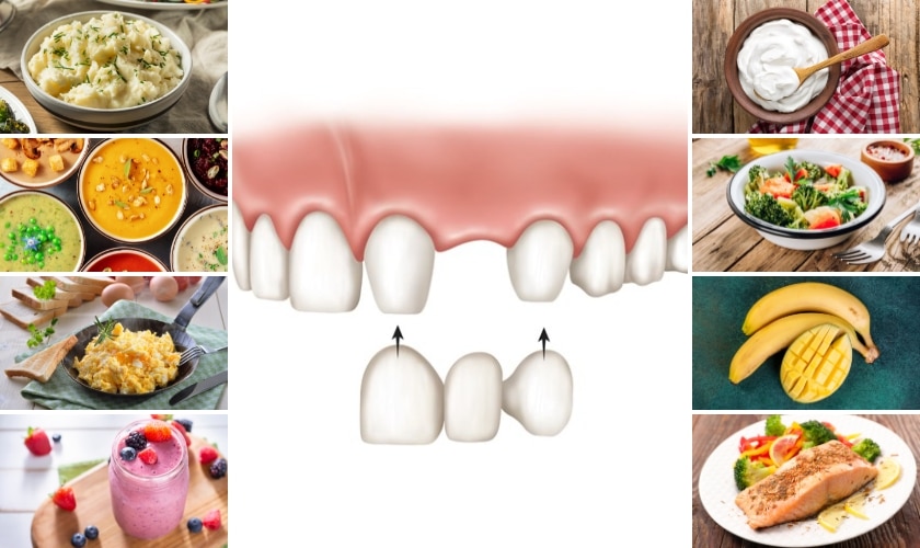 soft diet strategies after dental bridge placement