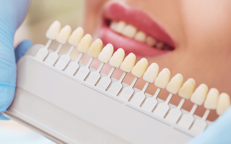 Tips To Maintain Your Dental Veneers