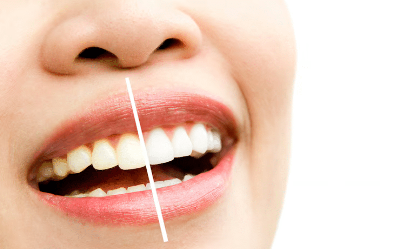 whiten your teeth in a week quick fixes for last-minute events